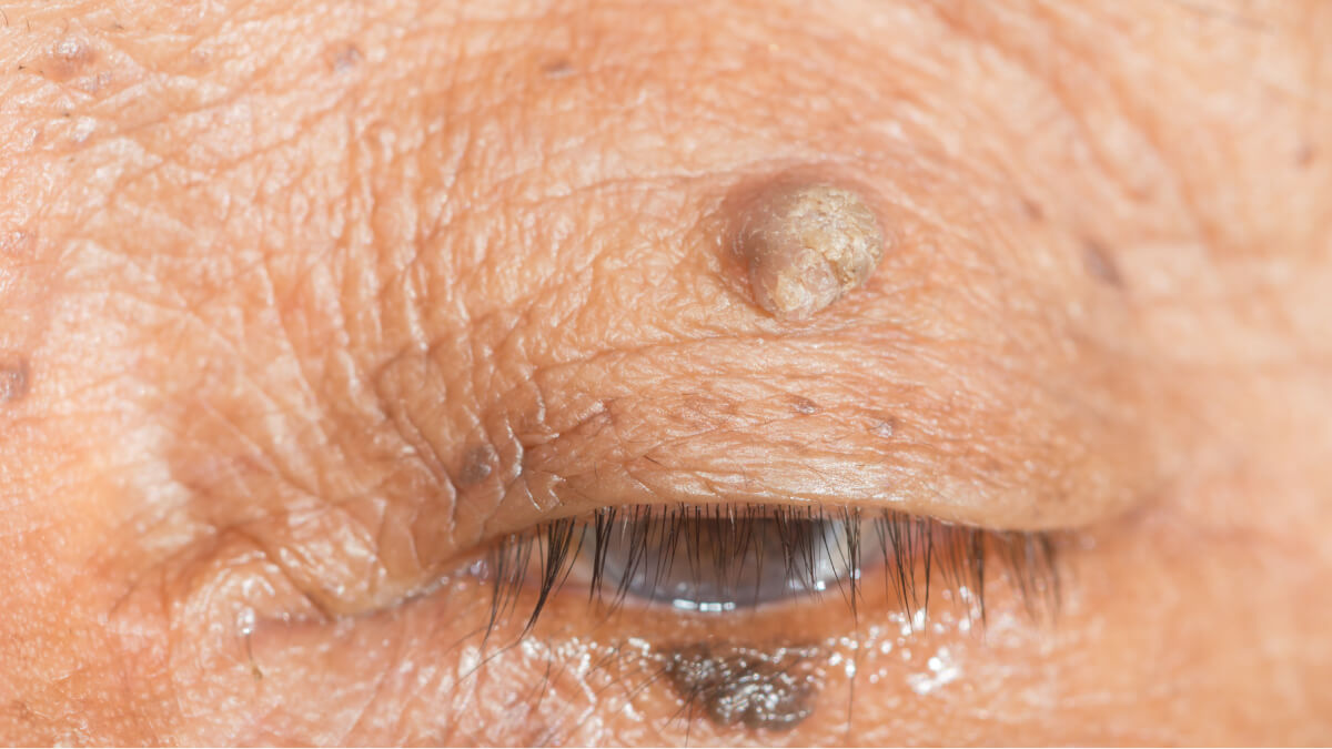 Eye skin tag