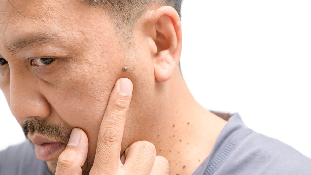 Pointing at skin tag