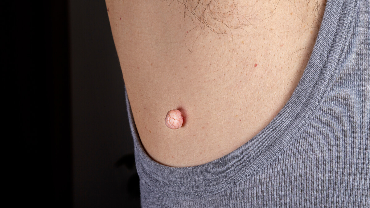 Skin tag armpit
