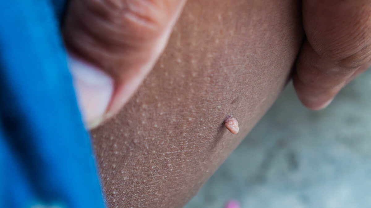 Skin tag examination