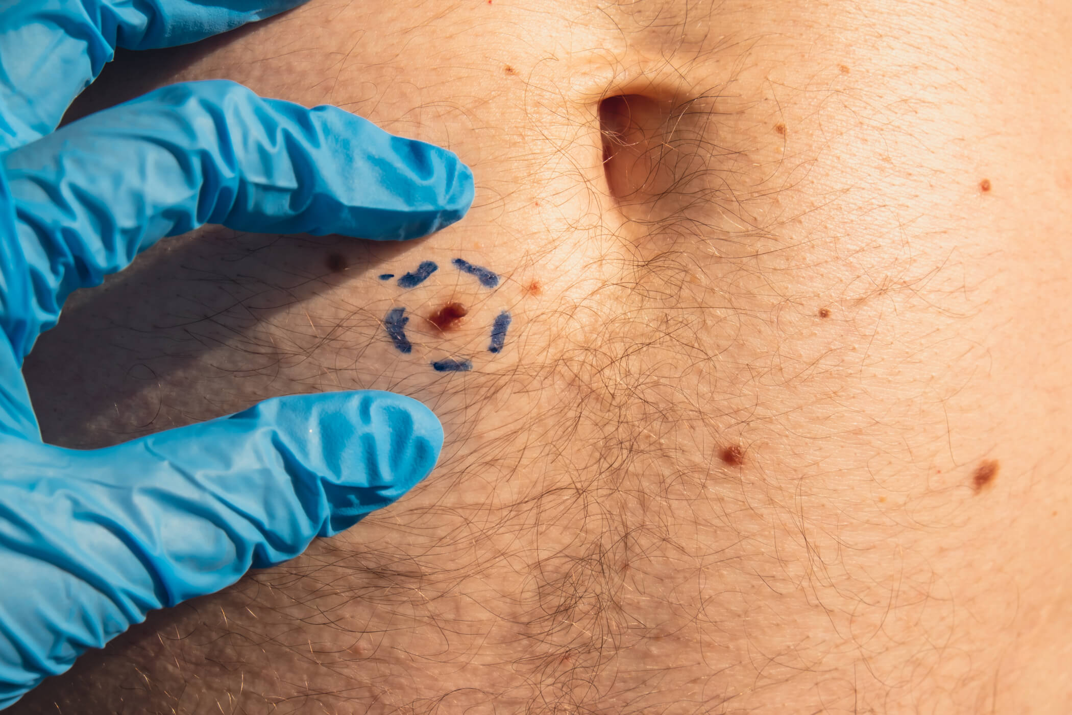 Skin tag removal