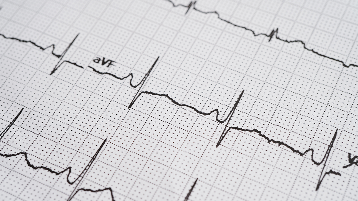 ECG readings