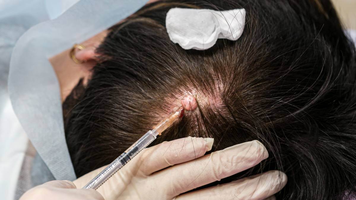 Cyst Being Injected