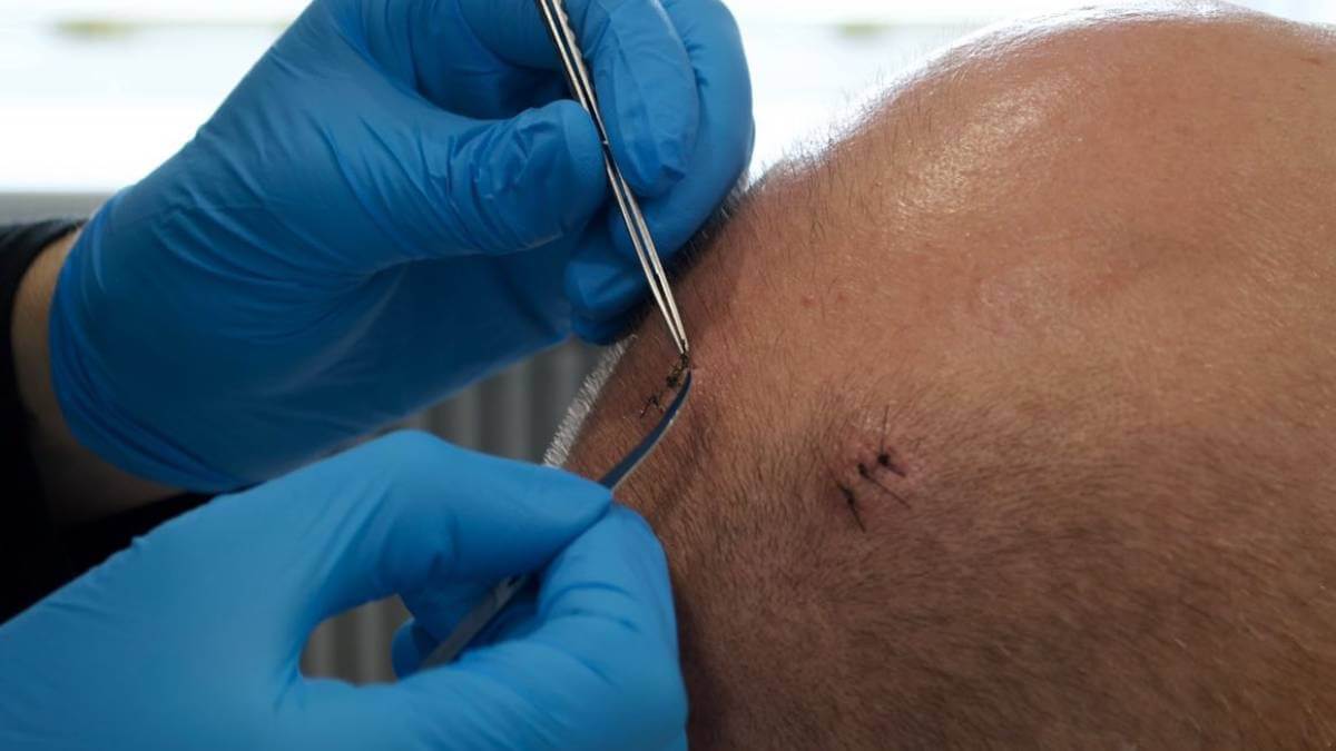 Cyst Being Stitched Up