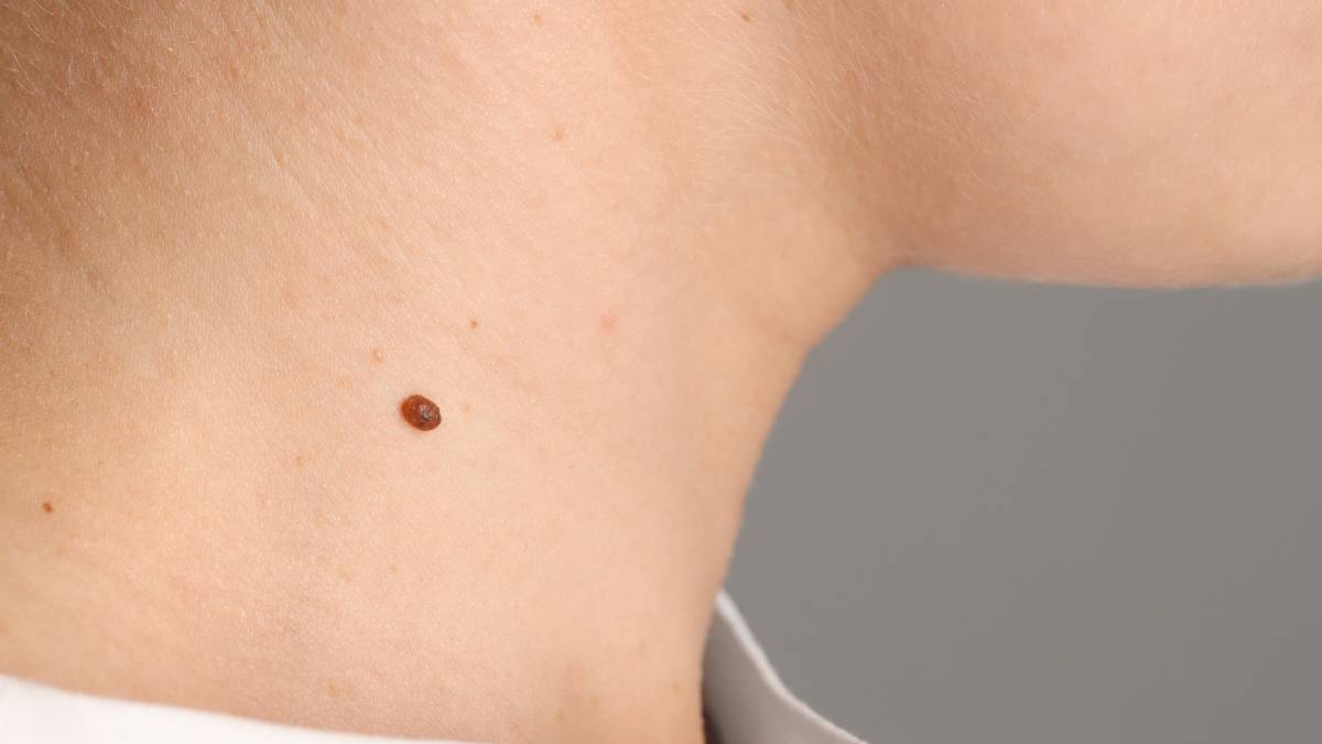 mole on neck