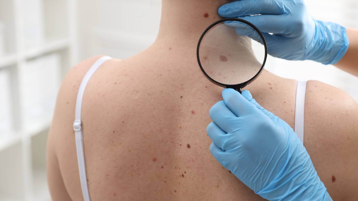 mole on the back